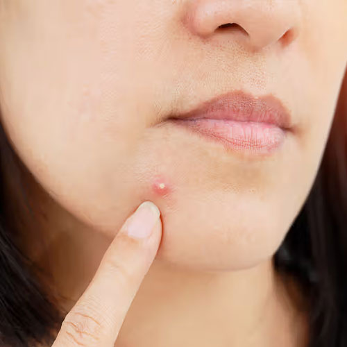 Skin Care Tips: शादी से पहले चेहरे पर निकल गए हैं ढेर सारे पिंपल्स, तो इस तरह करें स्किन केयर