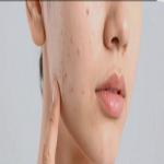 Beauty: ​मानसून में पिंपल्स का परमानेंट इलाज, जानें त्वचा को बेदाग रखने के अनोखे सीक्रेट्स