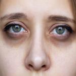 डार्क सर्कल्स : आंखों के आसपास के ये काले घेरे शारीरिक थकान का भी देते हैं संकेत