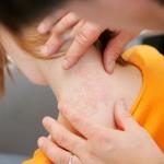 एक्जिमा की टेंशन झट से हो जाएगी दूर, इस तरह करें स्किन केयर