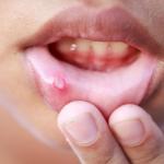 गर्मियों में अचानक हो जाते हैं मुंह में छाले, घरेलू तरीकों से करें ठीक