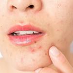 Skin Care Tips: चेहरे पर दिखने लगे हैं ढेर सारे मुंहासे, तो इस तरह इस्तेमाल करें शहद