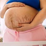 गर्भावस्था में स्ट्रेच मार्क्स? आयुर्वेद से जानिए बचाव के उपाय 