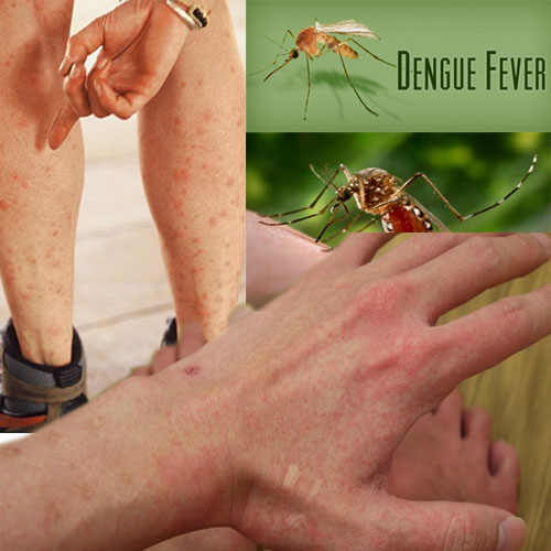 10 घरेलू टिप्स: डेंगू बुखार से बचने के 