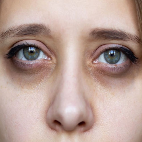 डार्क सर्कल्स : आंखों के आसपास के ये काले घेरे शारीरिक थकान का भी देते हैं संकेत