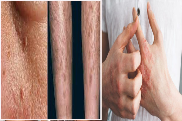 त्वचा को प्रभावित करता है मधुमेह, इन 9 लक्षणों से जाने