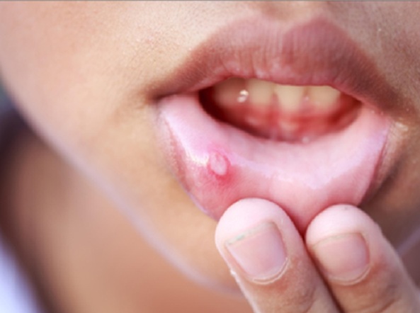 शरीर में पित्त बढ़ने का संकेत है बार-बार मुंह में हो रहे छाले, अनदेखा करना पड़ सकता है भारी
