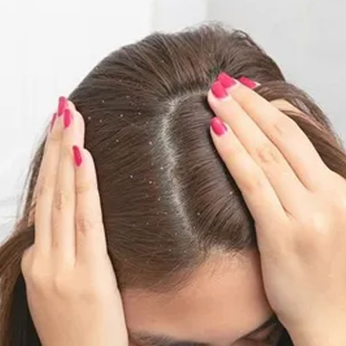 Hair Care: सर्दियों में बढ़ गई है डैंड्रफ की प्रॉब्लम, घरेलू तरीके से करें ठीक