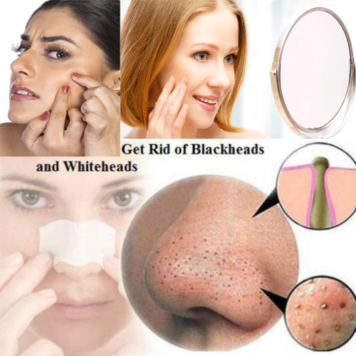 Natural Tips:किशोरवस्था में whiteheads व blackheads से पाएं छुटकारा