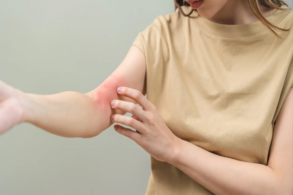 Skin Care Tips: बरसात में त्वचा पर बढ़ जाती है खुजली? इन आसान तरीकों से पाएं राहत
