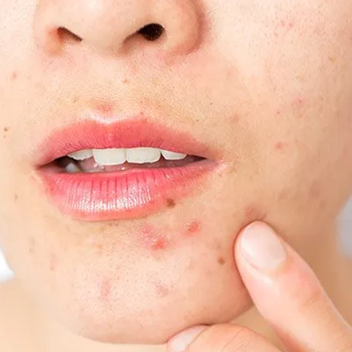 Skin Care Tips: चेहरे पर दिखने लगे हैं ढेर सारे मुंहासे, तो इस तरह इस्तेमाल करें शहद