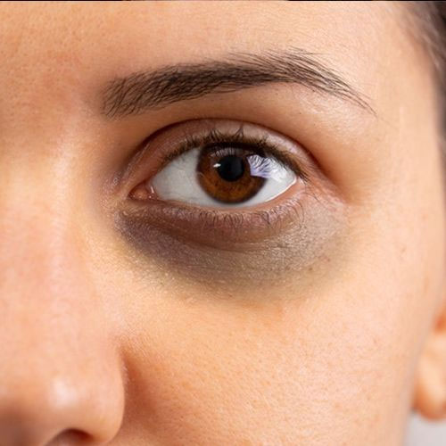 Skin Care Tips: आंखों के नीचे बन गए हैं काले घेरे, तो इन सिंपल ट्रिक्स से हटाएं