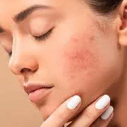 Skin Care Tips: चेहरे पर नजर आ रहे हैं हद से ज्यादा दाग धब्बे, तो इस तरह करें केयर