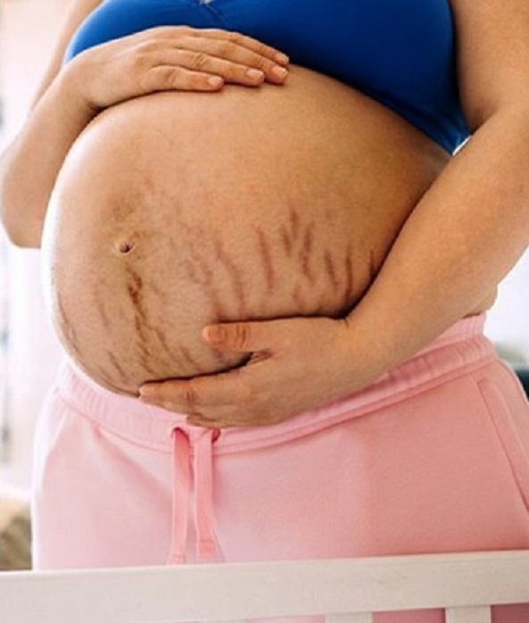 गर्भावस्था में स्ट्रेच मार्क्स? आयुर्वेद से जानिए बचाव के उपाय 