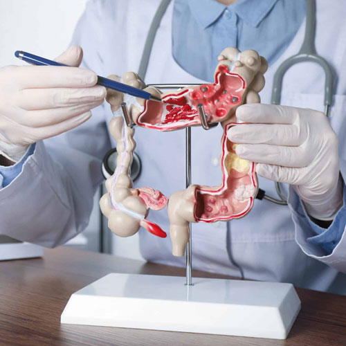 चुपचाप पैर पसारती है ये आंत से जुड़ी बीमारी, लक्षणों को न करें अनदेखा