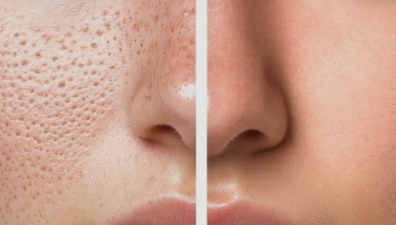 Beauty Tips : चेहरे के ओपन पोर्स से हैं परेशान? अपनी स्किन टाइप के अनुसार चुनें सही समाधान और पाएं बेदाग निखार